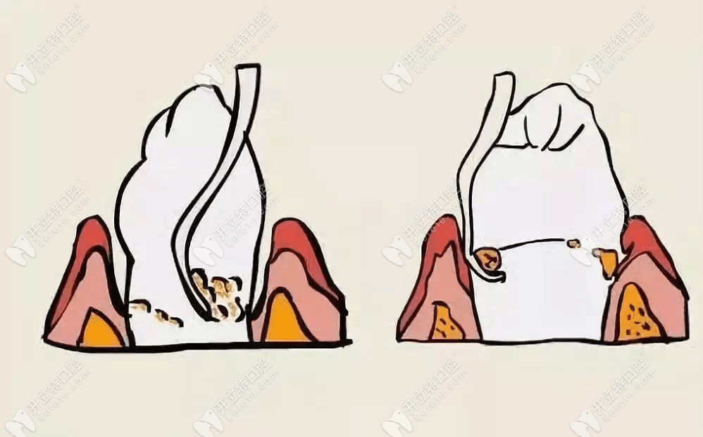牙周刮治价格多少钱一颗? 牙周刮治价格多少钱一颗?