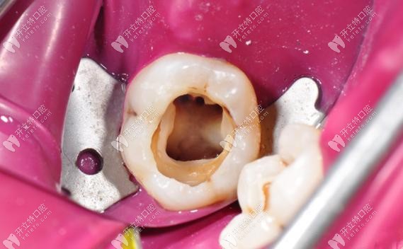 我补牙后不久材料就脱落了啥原因?去医院可以要求重新补吗